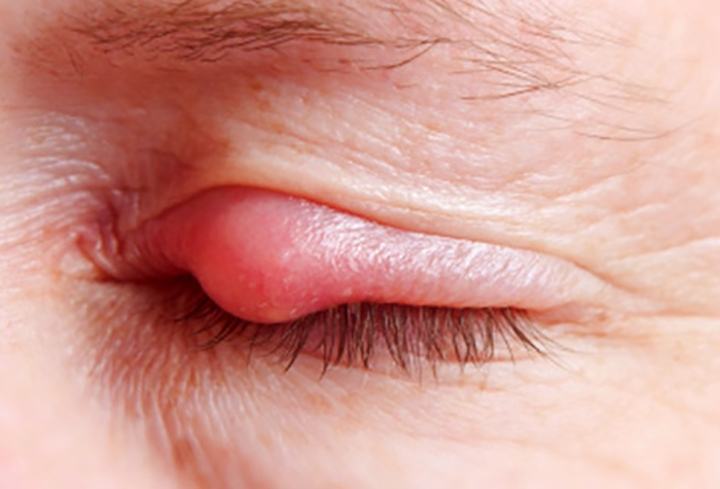 Bị đau mắt hột kiêng gì để không làm bệnh nặng thêm?
