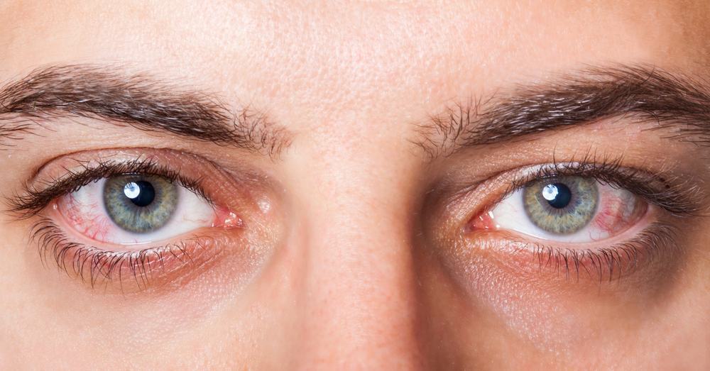 Bệnh đau mắt đỏ có lây không và lây sang con đường nào?