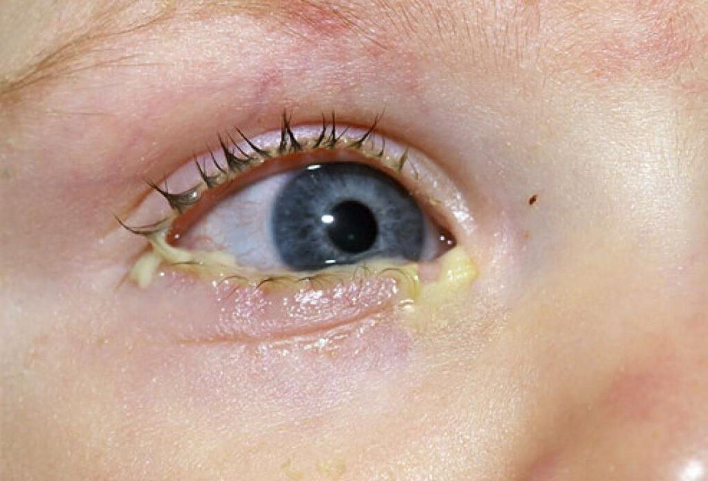 Đau mắt đỏ chảy dịch vàng hoặc xanh là do đâu?