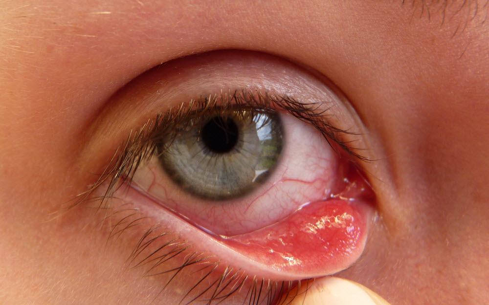 Đau mắt đỏ uống kháng sinh gì?