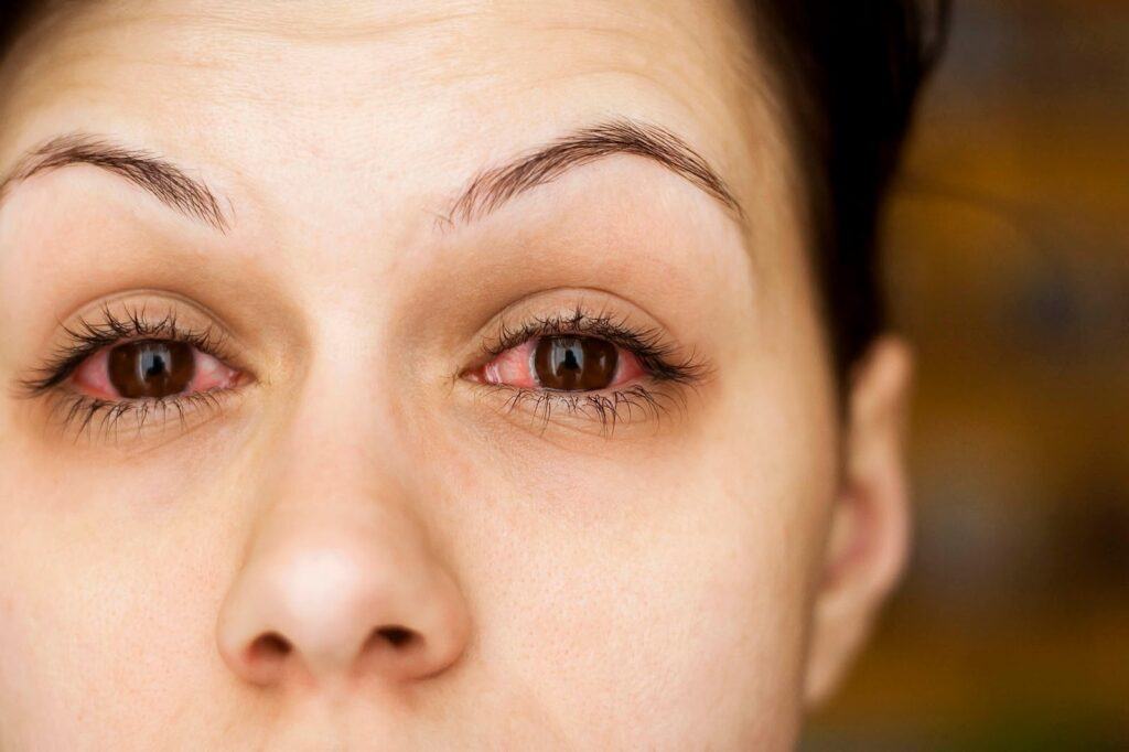 Những điều cần tránh khi bị đau mắt đỏ