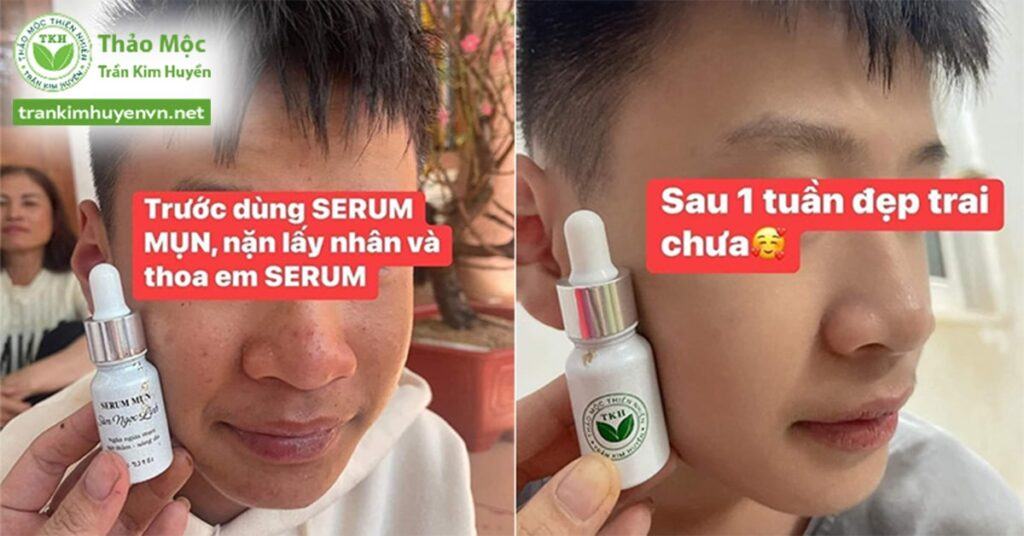 Phản hồi về sản phẩm serum mụn Sâm Ngọc Linh